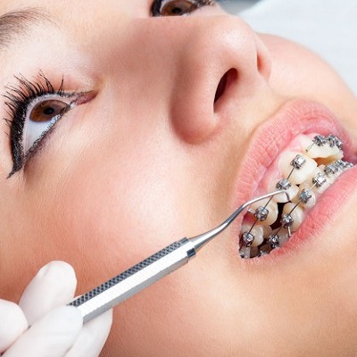 Dental Braces Cost In Abu Dhabi