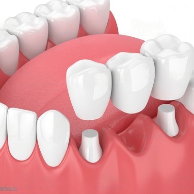 Dental Crown and Bridges 2 Dental Crown and Bridges in Abu Dhabi