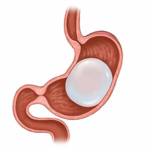 Blog 1 Gastric Balloon Cost in Abu Dhabi