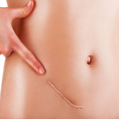 Laser Scar Removal Cost in Abu Dhabi