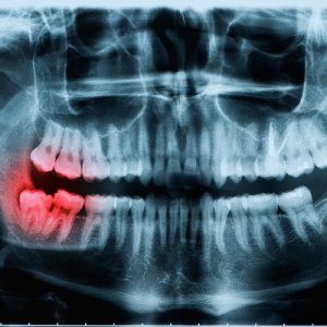 Dental Panoramic x-ray 2 Panoramic Dental X Ray in Dubai