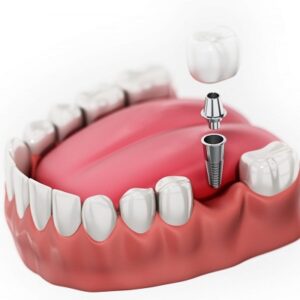Blog 5 Single Tooth Implant Cost in Abu Dhabi
