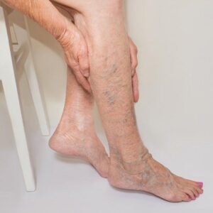 Blog 17 Varicose Veins Treatment Cost in Abu Dhabi
