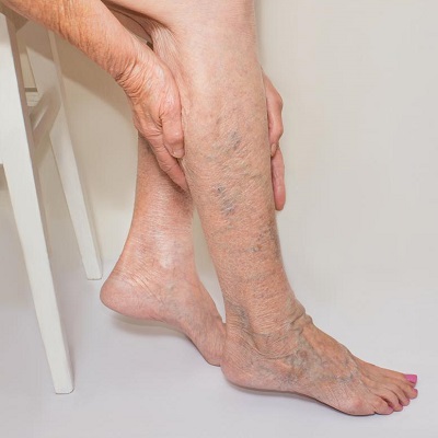 Varicose Veins Treatment Cost in Abu Dhabi