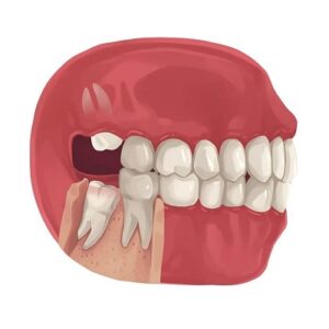 Blog 1 Wisdom Tooth Extraction Cost In Abu Dhabi