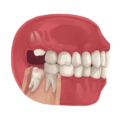 Wisdom Tooth Extraction Cost In Abu Dhabi