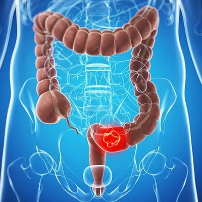 Colorectal Cancer Treatment in Abu Dhabi