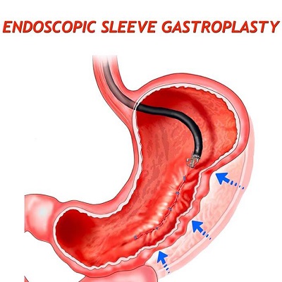 Endoscopic Sleeve Gastroplasty 2 Endoscopic Sleeve Gastroplasty Abu Dhabi