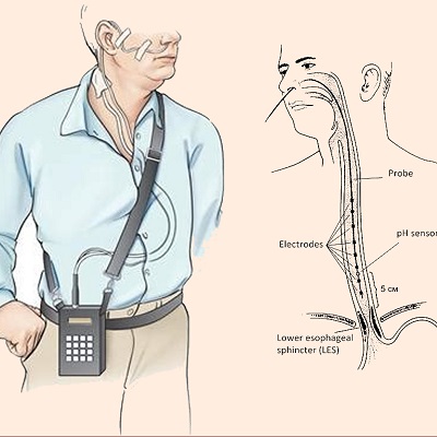 Esophageal PH Test in Abu Dhabi