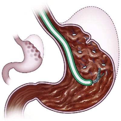 Primary Obesity Surgery Endoluminal