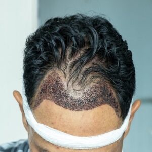 Blog 11 Front hairline hair patch price in Abu Dhabi