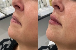 before & after lip filler injection in abu dhabi