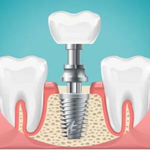 Blog 9 dental implant cost in abu dhabi