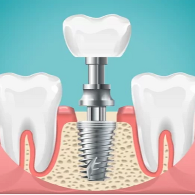 dental implant cost in abu dhabi