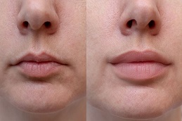 lip filler injection before & After