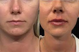 lip filler injection in abu dhabi before & after