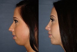 Rhinoplasty (Nose Job) 3 rhinoplasty in abu dhabi before & after