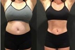 Allurion Gastric Balloonin abu dhabi & al ain