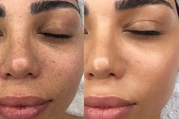 Skin Glowing Injections 4 Best Skin Glowing Injections in abu dhabi & Al Ain