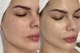 Skin Glowing Injections 5 Best Skin Glowing Injections in abu dhabi