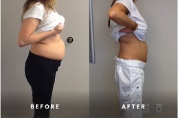 Mounjaro Treatment in abu dhabi before & after