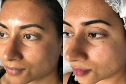 Skin Glowing Injections 3 before & after Best Skin Glowing Injections