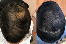 G Cell Treatment 6 before & after g cell hair treatment