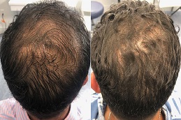 G Cell Treatment 7 before & after hair transplant in abu dhabi & al ain