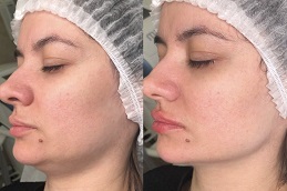 Aqualyx Before and After