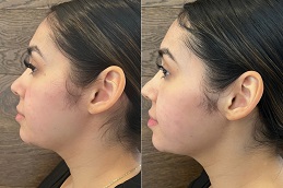 Aqualyx injection in abu dhabi before & after