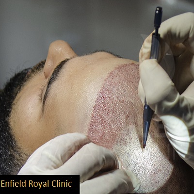 FUE Hair Transplant 2 FUE Hair Transplant in Abu Dhabi