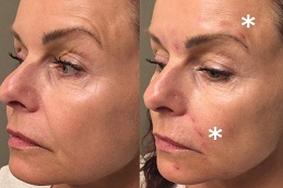 Face-mesotherapy before and after in abu dhabi