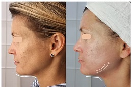 HIFU Treatment before and after