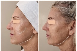 HIFU Treatment 8 Hifu treatment in abu dhabi before and after