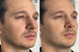 Jawline filler before & after