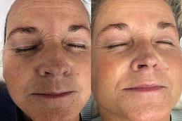 Mesotherapy in abu dhabi