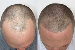 Scalp Micropigmentation 8 Scalp Micropigmentation in Abu Dhabi before and after