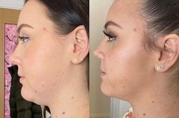 before & after Aqualyx injection in abu dhabi