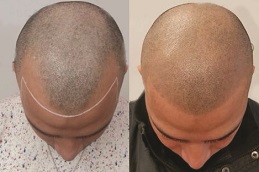 before & after Scalp Micropigmentation in abu dhabi & al ain