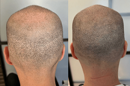 before & after Scalp Micropigmentation