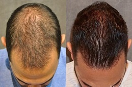 FUE Hair Transplant 5 before & after fue hair transplant in abu dhabi