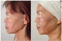 before & after hifu treatment in abu dhabi