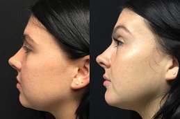 before & after jawline filler