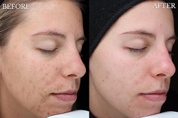 before and after chemical peel in abu dhabi