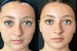 before and after dermal filler injection in abu dhabi