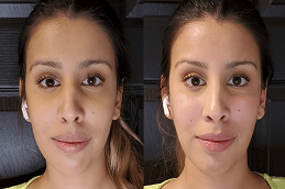 before and after filler injection in abu dhabi