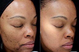 Chemical Peels 5 chemical Peels in abu dhabi before and after