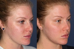 chemical peel in abu dhabi and al ain before and after