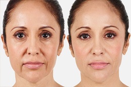 dermal filler injection in abu dhabi