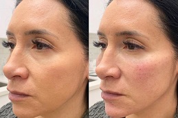 filler injection in abu dhabi & al ain